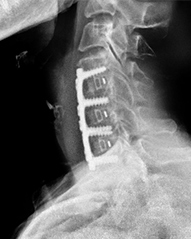 Anterior cervical discectomies