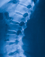 lumbar spondylolisthesis