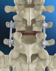 What Is the Comparison in Robot Time per Screw, Radiation Exposure, Robot Abandonment, Screw Accuracy, and Clinical Outcomes Between Percutaneous and Open Robot-Assisted Short Lumbar Fusion?: A Multicenter, Propensity-Matched Analysis of 310 Patients 